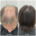 PRP Hair Treatment