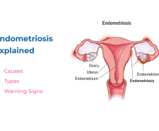 Endometriosis Explained