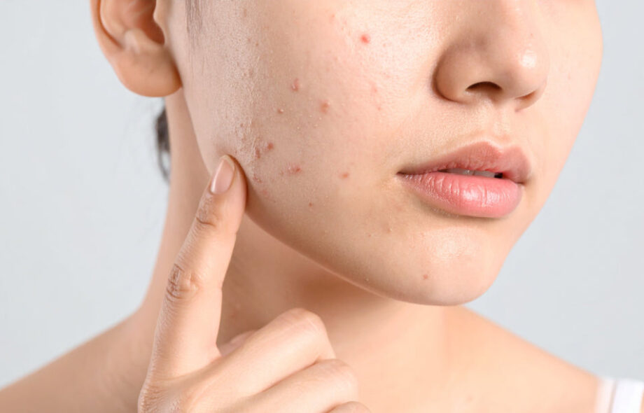 Top Providers of Acne treatment in Dubai for Long-Term Results - InsideTechie